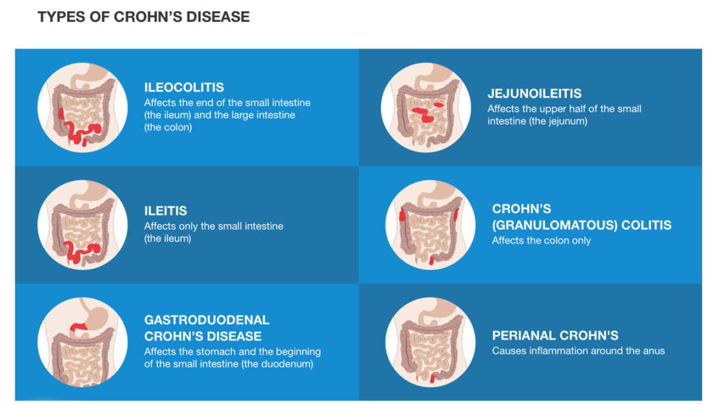 Microscopic rendering of intestinal tissue in Crohn’s Disease, showing deep-layer inflammation and lesions.