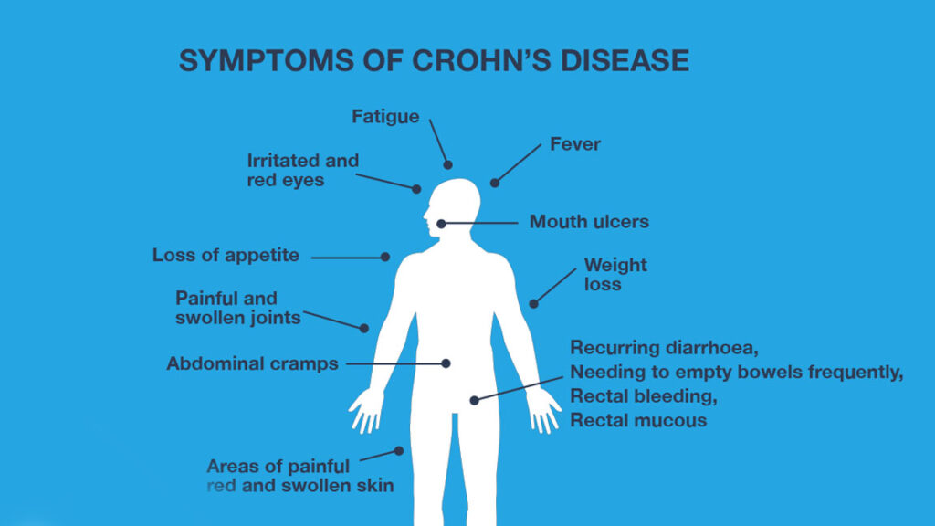 Endoscopic illustration showing inflamed colon in a patient with Crohn’s Disease Symptom's