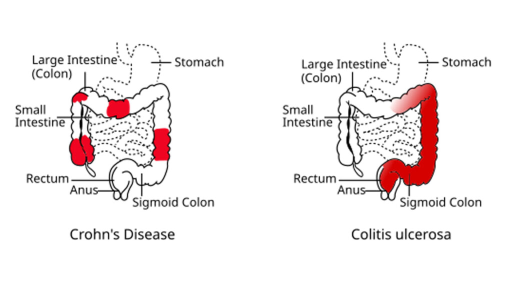 Medical diagram comparing Crohn’s Disease and Ulcerative Colitis showing differences in location and inflammation pattern
