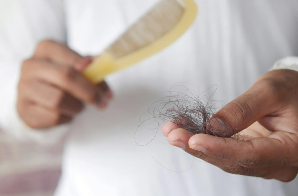 Hair fall due to scalp microbiome imbalance.